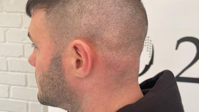 Transplant scare image