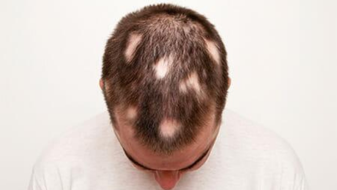 Alopecia treatment