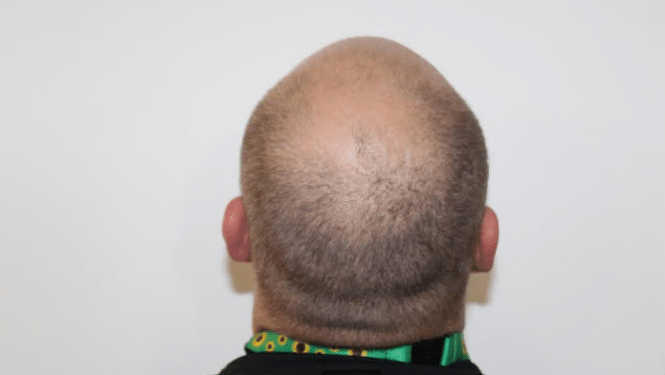 close up thinning hair