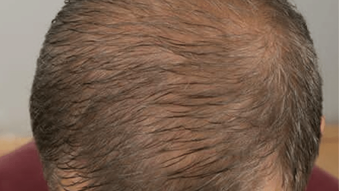 solve hair thinning